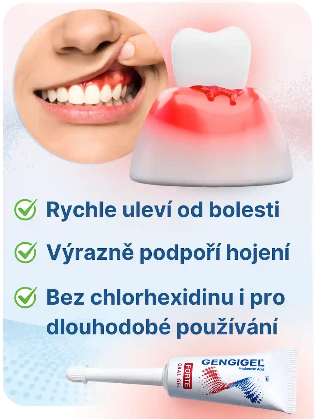 GENGIGEL® Forte – rychle zklidňuje zánět dásní